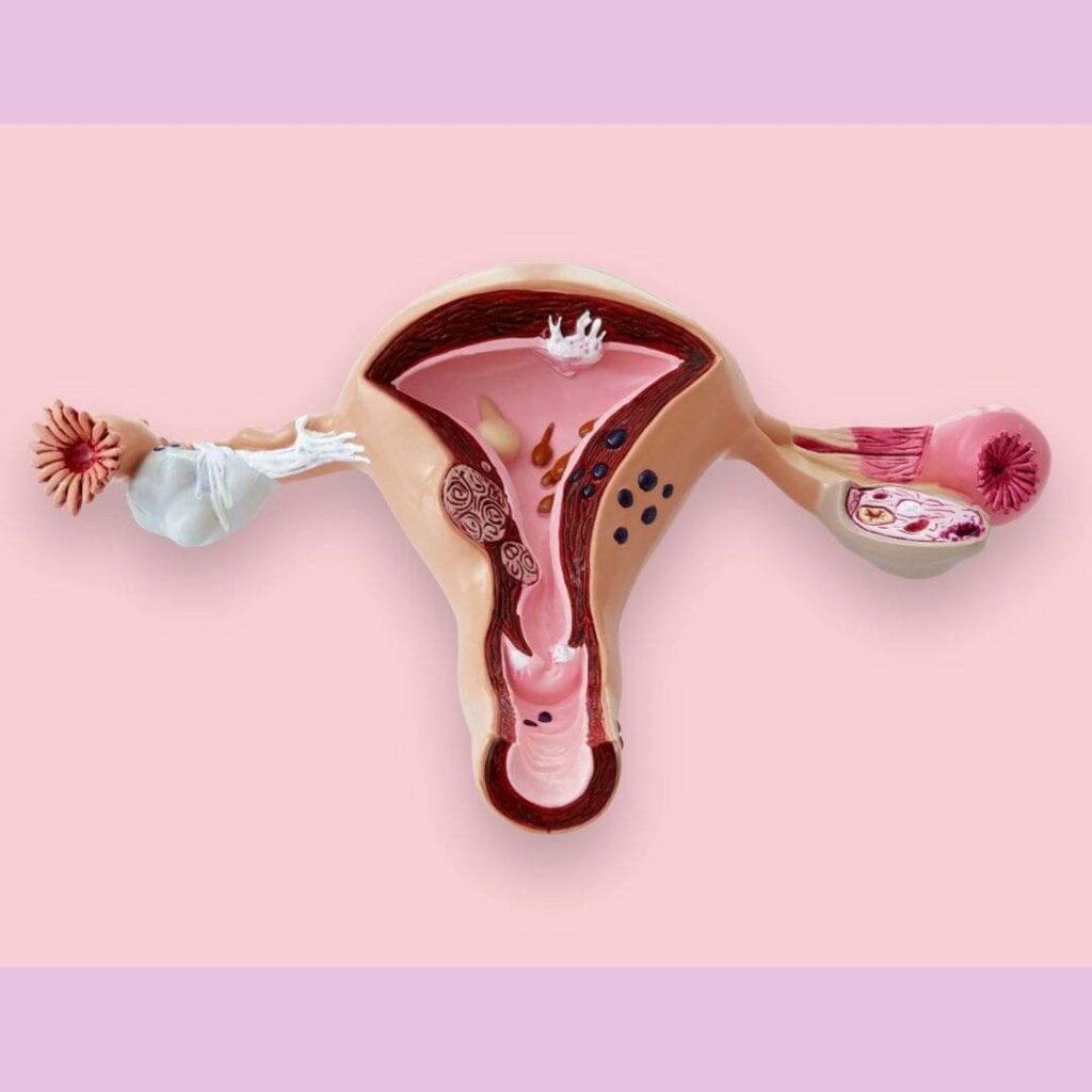 utérus endométriose ayurveda